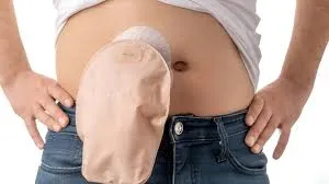 Life Expectancy With a Colostomy Bag