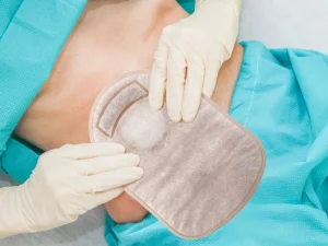 What to Expect After Ostomy Surgery Recovery