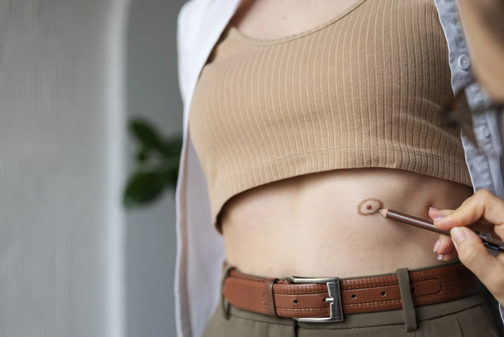 Why Ostomies Happen