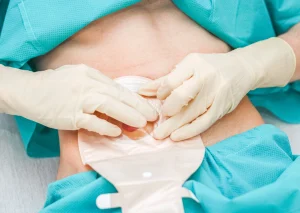 What Happens to Your Anus After a Colostomy