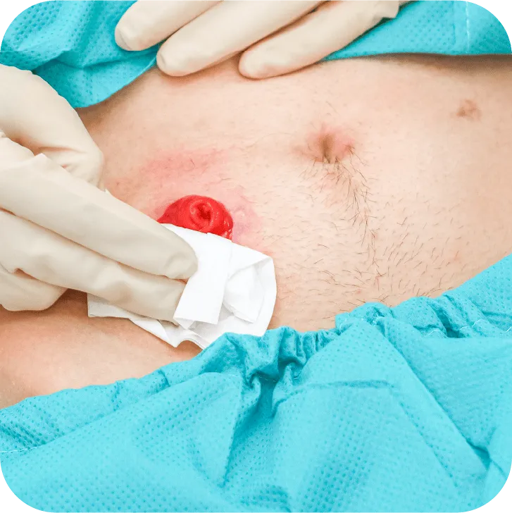 Ostomy Steps 2. Protect