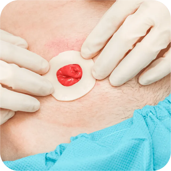 Ostomy Steps 3. Secure