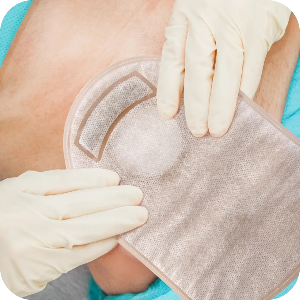 Ostomy Steps 5. Apply