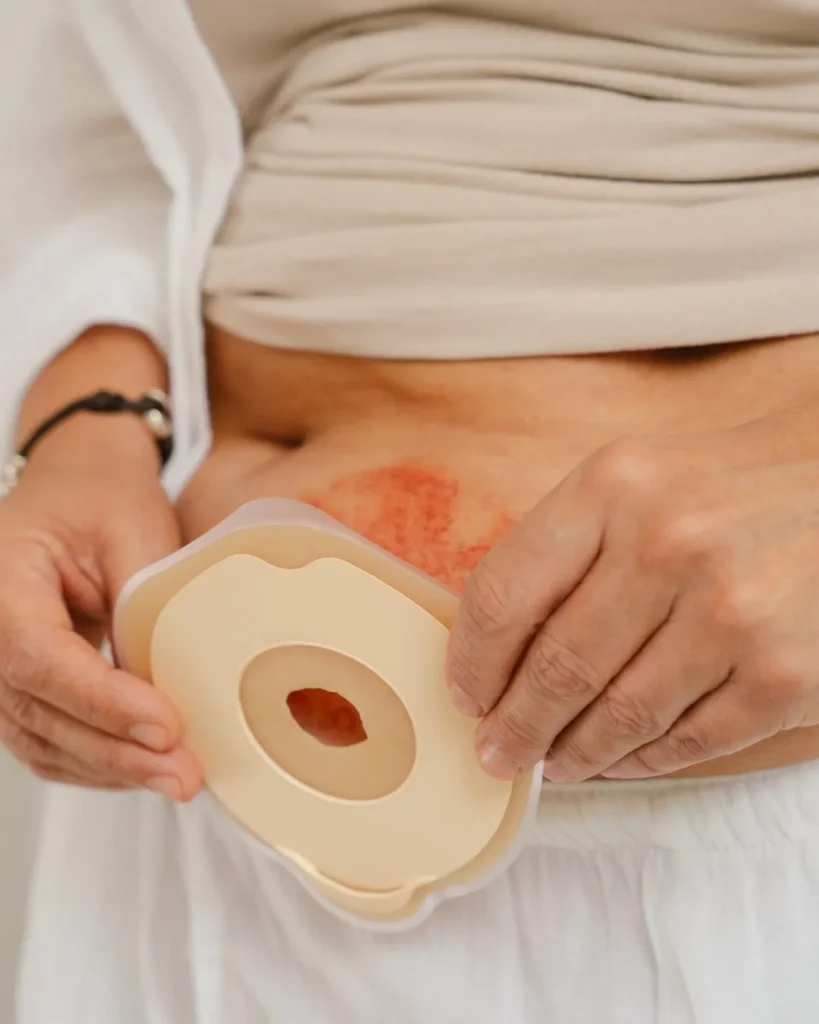 How to Protect the Skin Around Your Stoma: A Peristomal Skin Care Guide